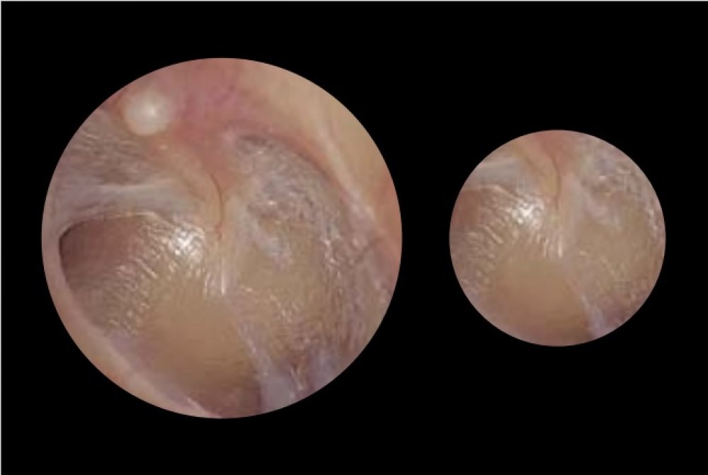 Portable Otoscope PMV, 3.5V, LED